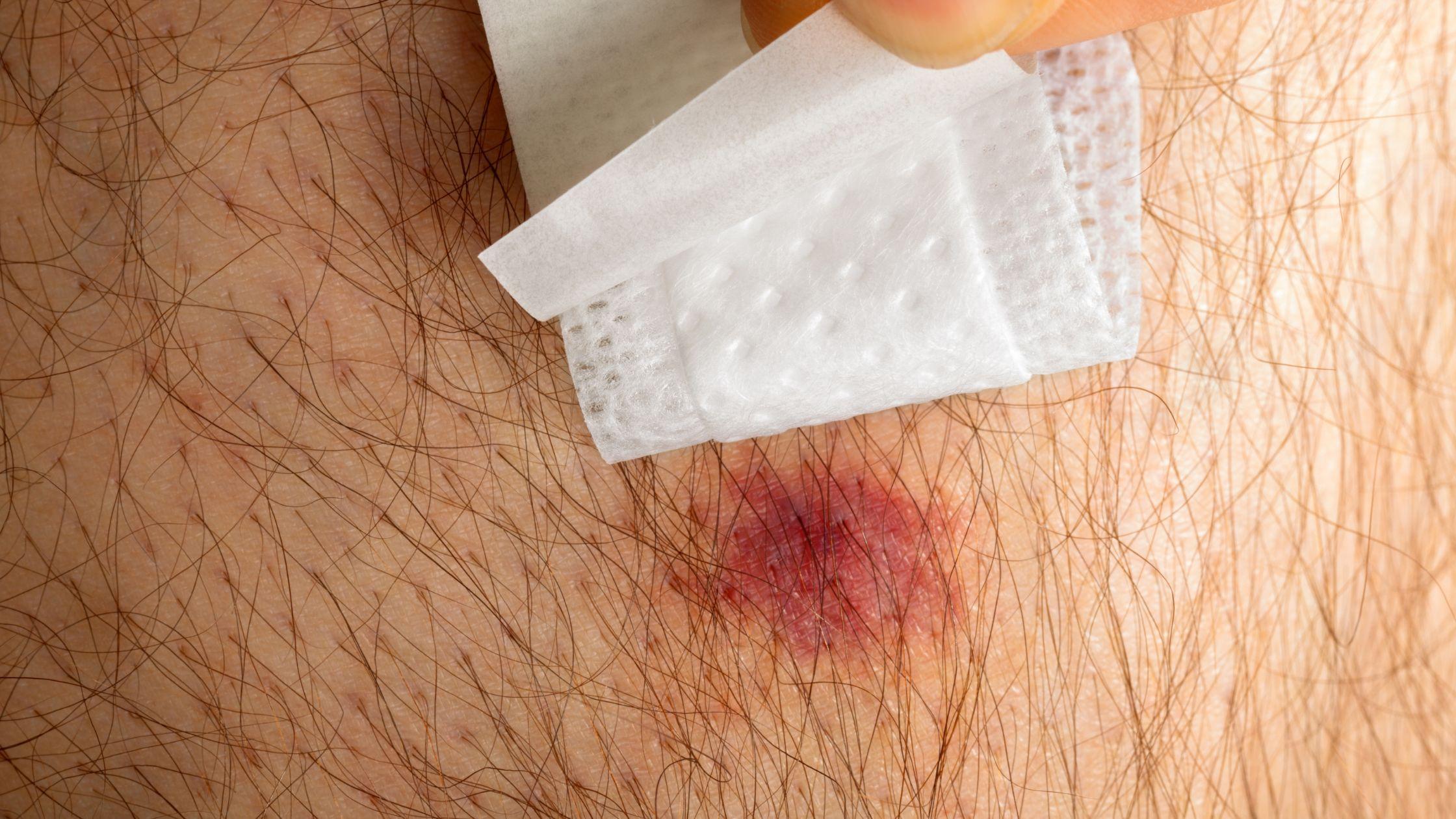 A spider bite on skin being shown under bandage 